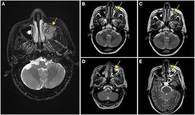 Case Report: Bortezomib Plus CDOP Followed by Sequential Autologous Hematopoietic Stem Cell Transplantation and Lenalidomide-Based Maintenance Therapy in Plasmablastic Lymphoma